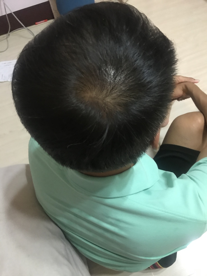 點我看大圖 去年疫情剛爆發 開始戴irestore的簡單分享