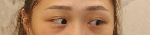 眼袋手術 滿意成果分享