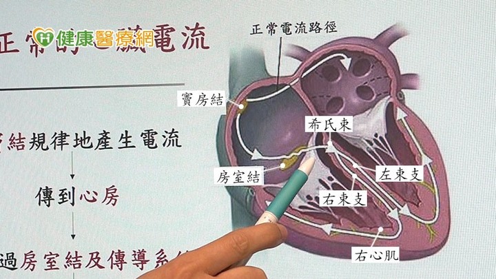 七旬翁瀕臨心衰竭！「生理性心臟節律器」治療