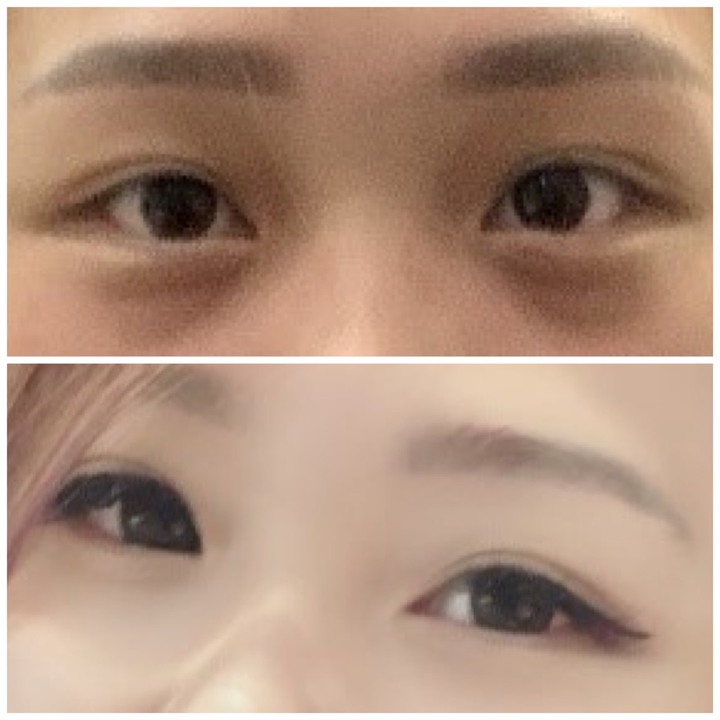 眼袋手術 滿意成果分享