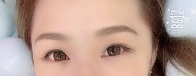 眼袋手術 滿意成果分享