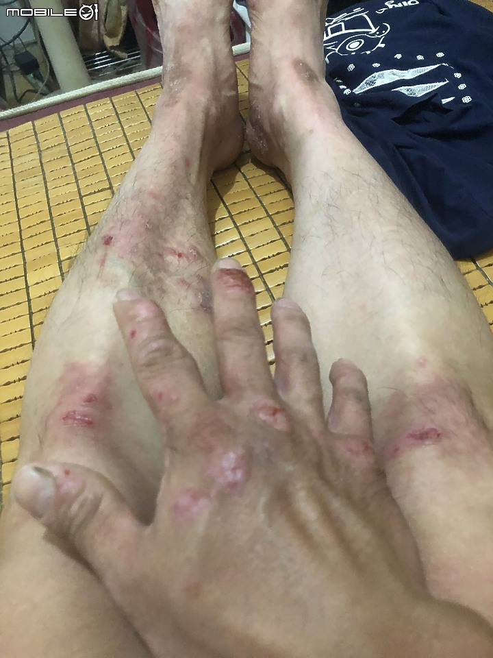 手腳慢性濕疹