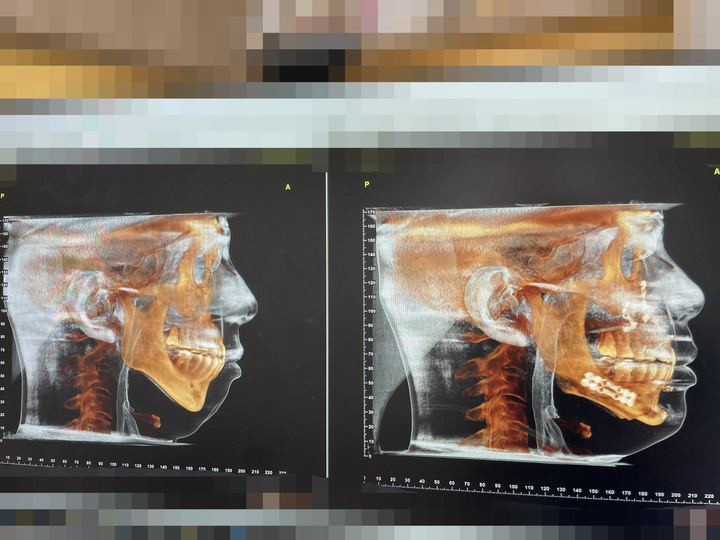 下巴後縮睡眠呼吸中止正顎分享