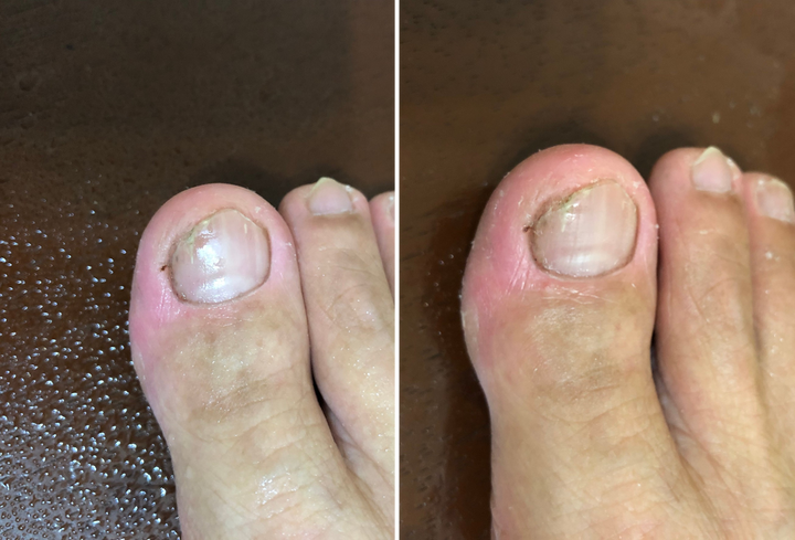 三種灰指甲藥使用評比