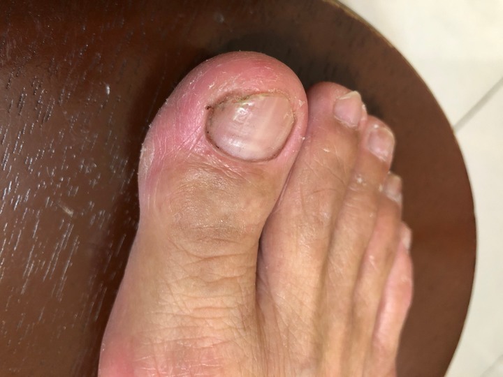 三種灰指甲藥使用評比