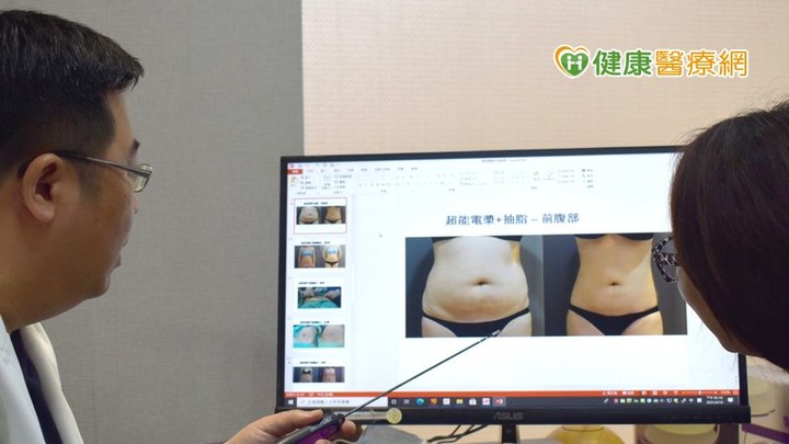 點我看大圖 警戒降級脂肪卻升級?複合式電漿抽脂避免凹凸不平