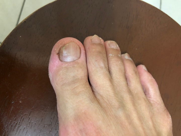 三種灰指甲藥使用評比