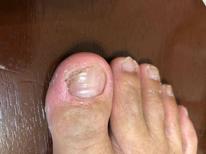 三種灰指甲藥使用評比