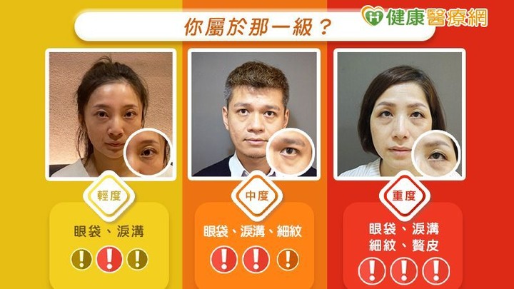 眼袋顯老無神怎麼救？複合式眼袋手術隱密上工