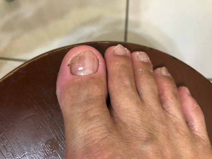 三種灰指甲藥使用評比