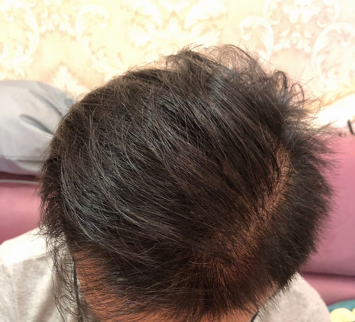 irestore生髮帽心得分享 拯救雄性禿髮旋頭頂毛髮