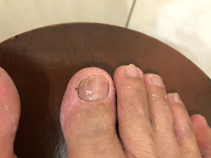 三種灰指甲藥使用評比