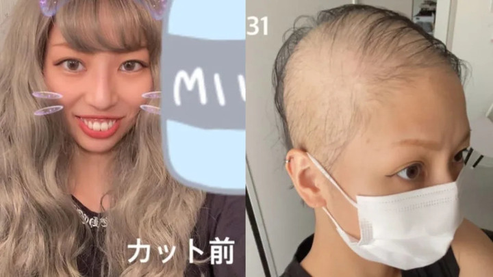 日女打莫德納狂掉髮！1個月後「接近全禿」親曝恐怖過程