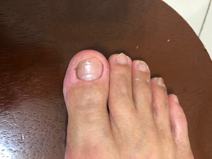 三種灰指甲藥使用評比