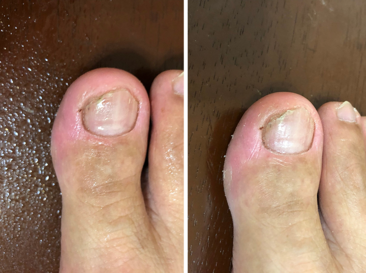 三種灰指甲藥使用評比