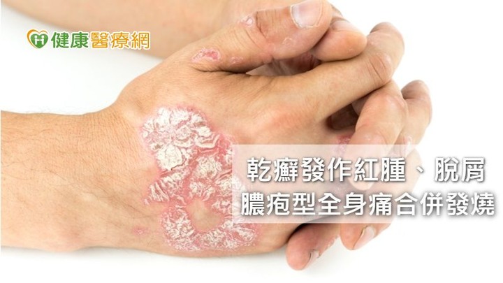 點我看大圖 乾癬怕停藥病情反撲更嚴重控制治療這樣做