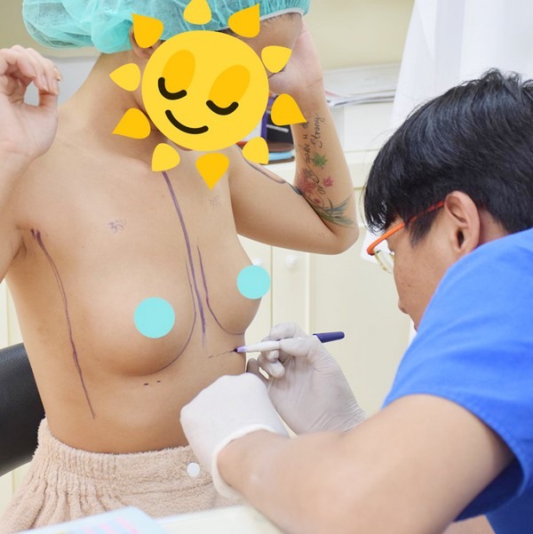 台中隆乳的經驗分享