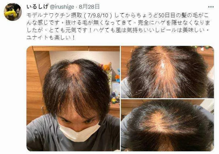 莫德納副作用有變秃頭嗎?