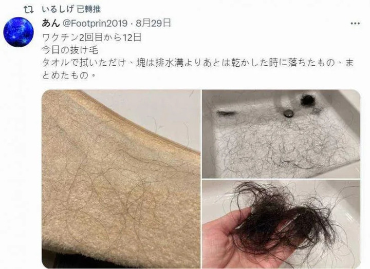 莫德納副作用有變秃頭嗎?
