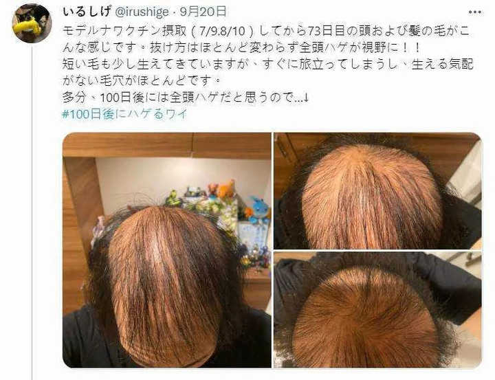 莫德納副作用有變秃頭嗎?