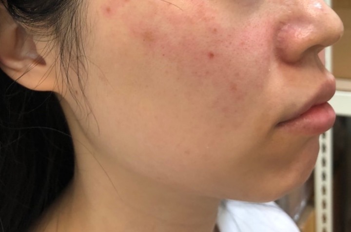 臉部拉提效果分享