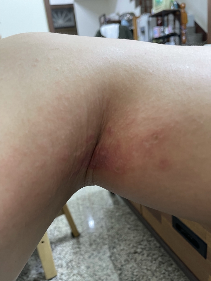 請問我這個是被什麼蟲咬到？