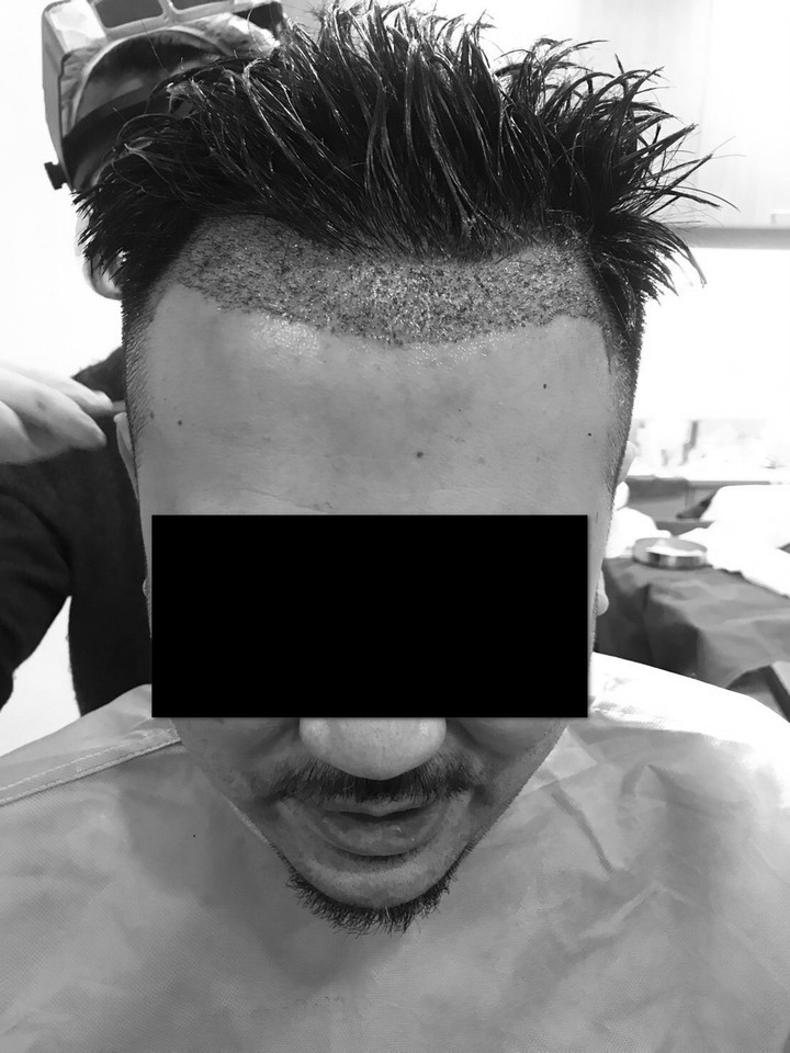 個人微創無痕植髮小記錄+心得