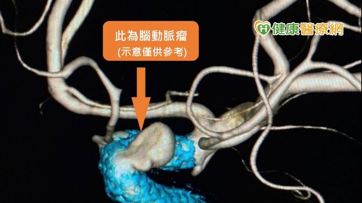 劇烈頭痛像被鐵鎚擊中當心腦動脈瘤找上門