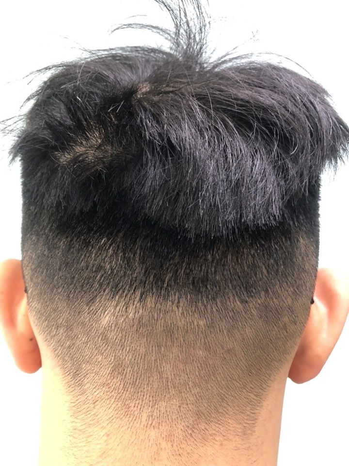 個人微創無痕植髮小記錄+心得