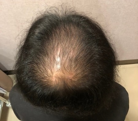 還好有去看醫生做生髮療程
