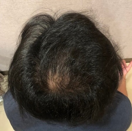 還好有去看醫生做生髮療程