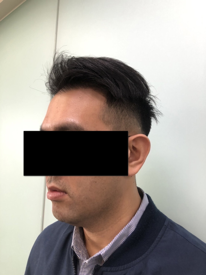 個人微創無痕植髮小記錄+心得