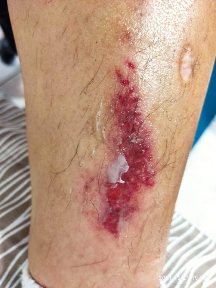 苗栗南庄老街靠右直行被左轉車撞車禍受傷