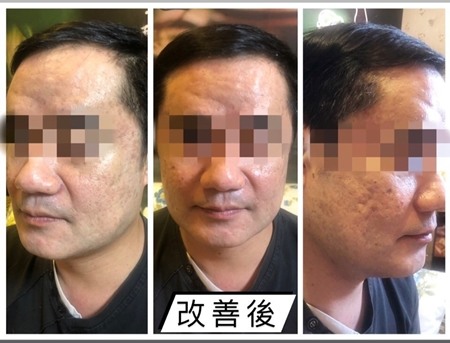 沒想到我的花臉也能改善