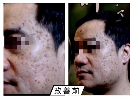 沒想到我的花臉也能改善