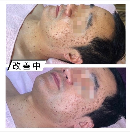 沒想到我的花臉也能改善