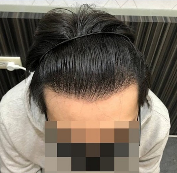 植髮後的成果分享