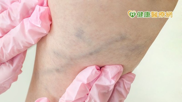 點我看大圖 腳腫如蚯蚓又痠麻輕鬆擺脫靜脈曲張就靠「它」
