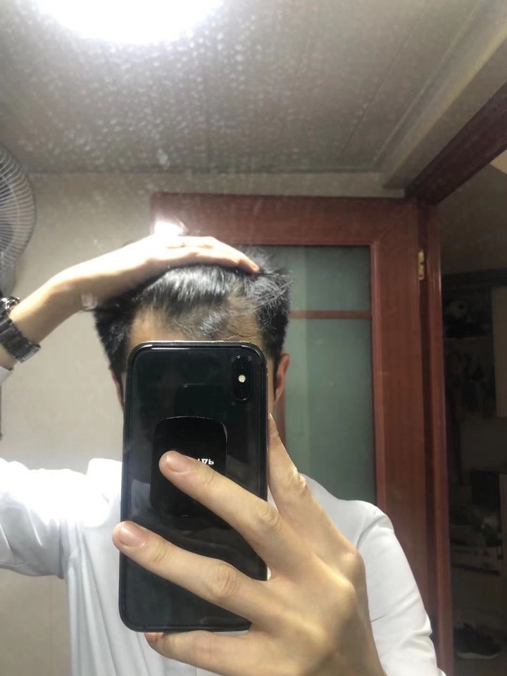 i-Hair植髮心得