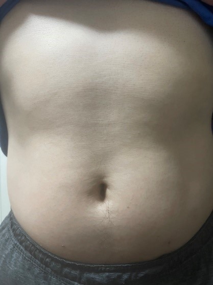 [求救 ]過30後急速變胖3個月後要拍婚紗…