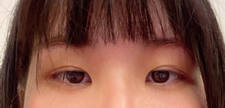 #分享 終於去縫雙眼皮了❤️