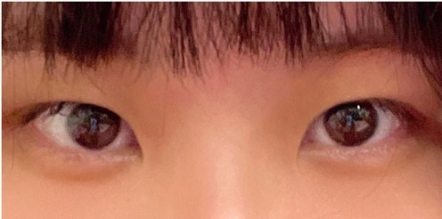 #分享 終於去縫雙眼皮了❤️