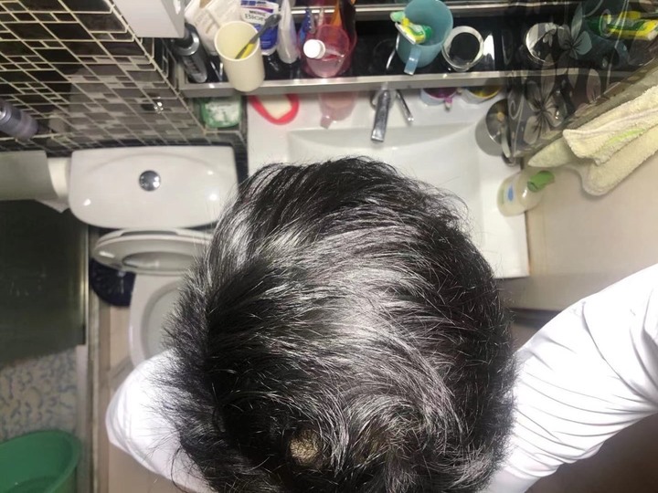 i-Hair植髮心得