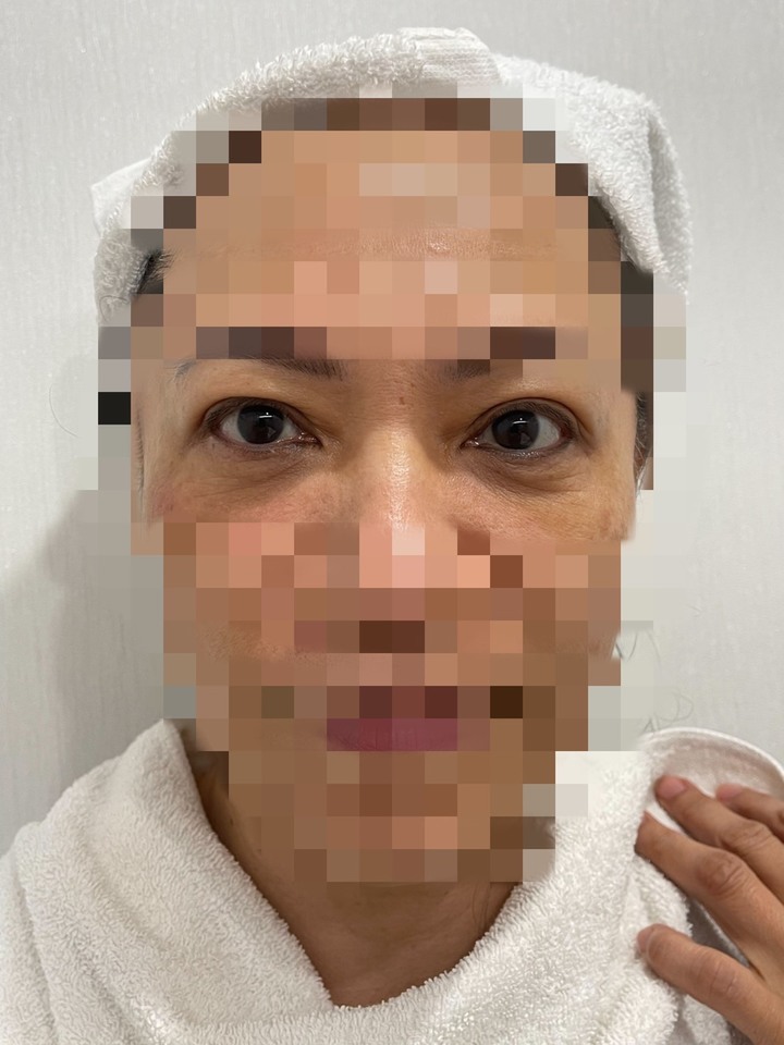 愛美又怕挨針的好選擇 晶瓷鑽心得