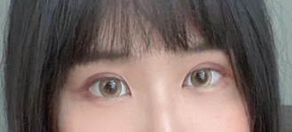 #分享 終於去縫雙眼皮了❤️
