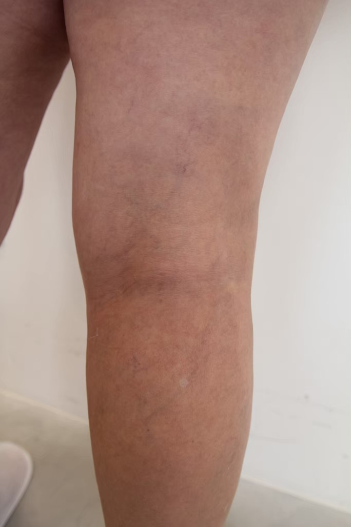 靜脈曲張治療分享 重回平坦健康腿