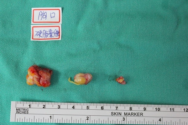 囊腫(粉瘤、脂肪瘤)反覆發炎切除經驗(有圖慎入)