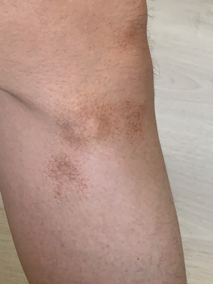 小腿上近半年來陸續出現的瘀青狀暗黑紅斑不明現象