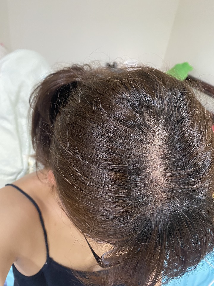 告別油膩膩 開心又美麗 — Alpecin Scalp care 專業頭皮護理系列