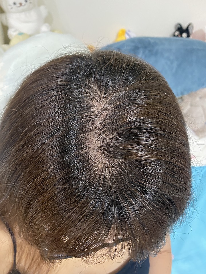 告別油膩膩 開心又美麗 — Alpecin Scalp care 專業頭皮護理系列